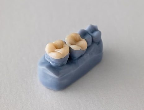 The Difference Between Inlays, Onlays, and Fillings