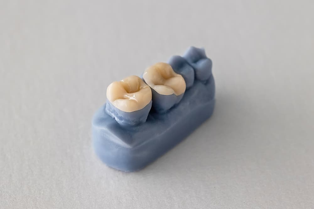 Inlays, Onlays, and Fillings