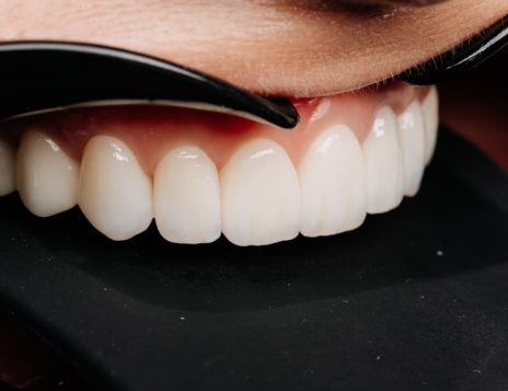 Dental Implants in Southampton: Supporting Oral Health and Everyday Function