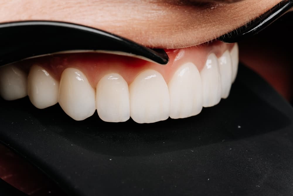 Dental Implants in Southampton